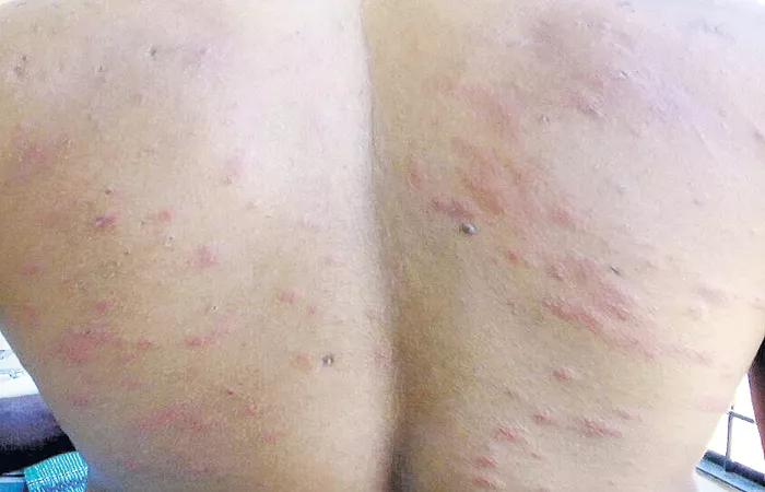 Skin allergy with Cotton - Sakshi