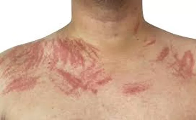 Dermatographia: Causes and treatment of skin writing - Sakshi