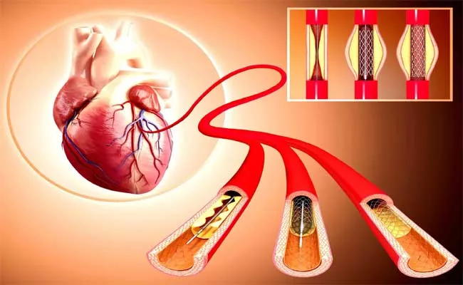 Treatment For Heart Arteries Clog Even After Stent - Sakshi