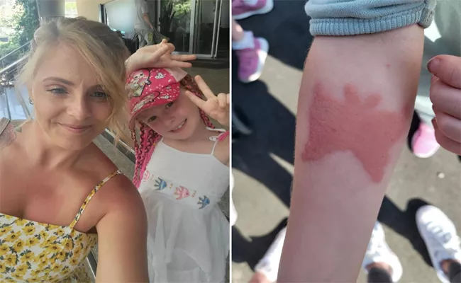 UK Mother Claims Henna Tattoo Left 7 Year-Old Girl With Chemical Burn - Sakshi