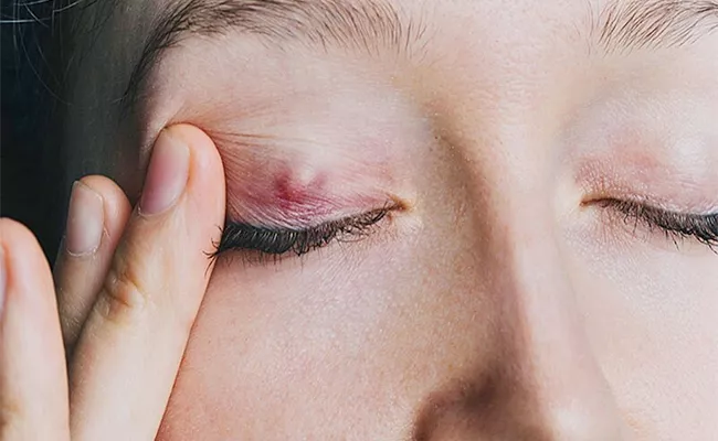 Eyelid bump: Symptoms Causes And Treatment - Sakshi