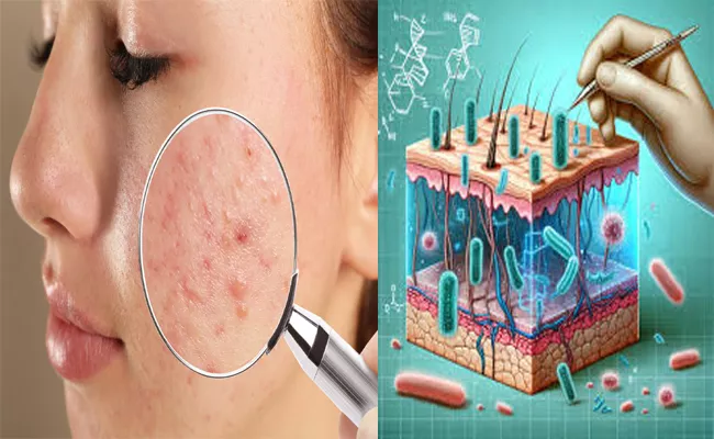 Scientists Engineer Skin Bacteria For Breakthrough Acne - Sakshi