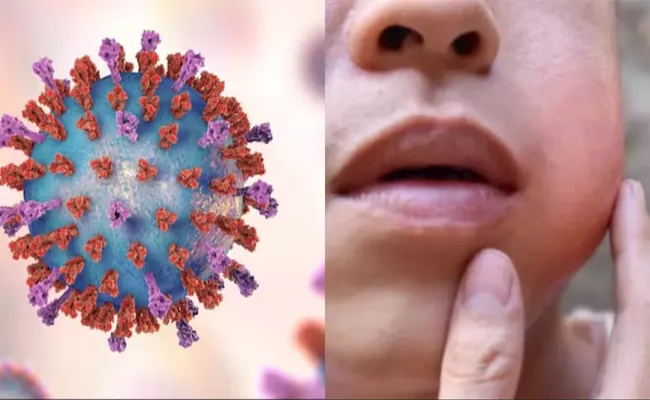 Mumps Outbreak In Kerala: Symptoms Treatment Prevention - Sakshi