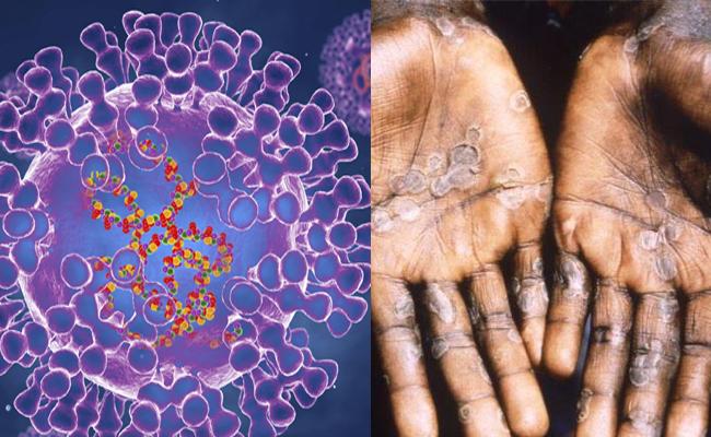 Monkeypox Virus Updates: United Arab Emirates Say Detects First Case ...