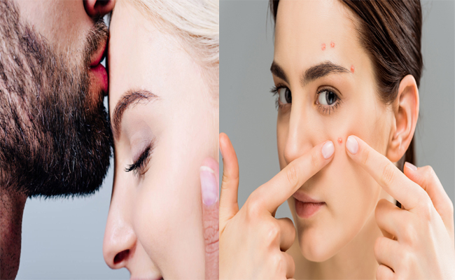 ముద్దు పెట్టుకోవడం వల్ల మొటిమలు వస్తాయా? | How Kissing And Touching ...