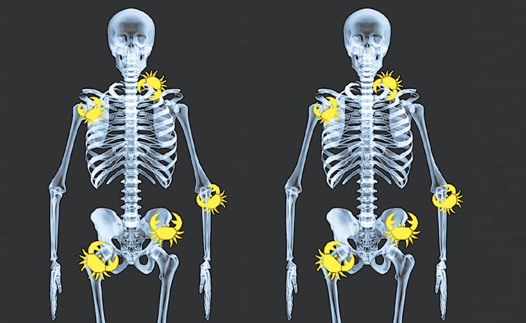 ఎముక క్యాన్సర్‌ అంటే...? | types of bone cancer | Sakshi