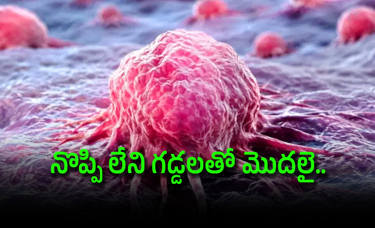 అరుదైన సార్కోమా క్యాన్సర్.. గుర్తించడం ఎలా