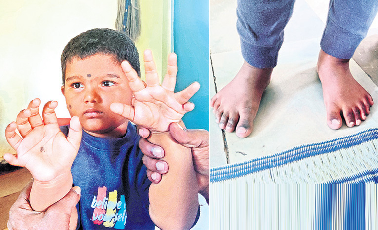అరుదైన వింత.. నాలుగేళ్ల బాలుడికి 24 వేళ్లు!