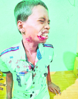 కుక్కల దాడిలో గాయపడిన శివకుమార్ (ఫైల్) 1