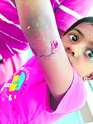 కోతుల దాడిలో చిన్నారికి గాయాలు
1
