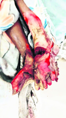 వేటగాళ్ల ఉచ్చులో పడి రైతుకు గాయాలు1
