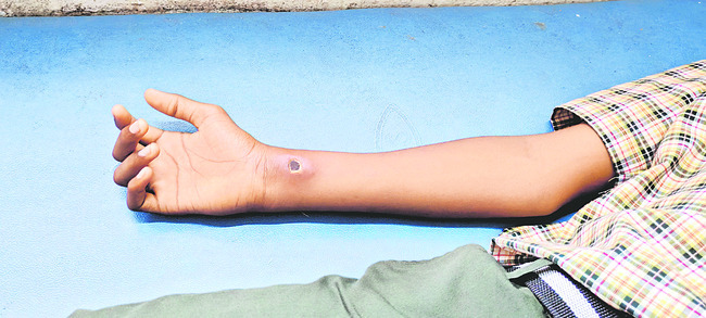 ఇంజక్షన్‌ వికటించి ఇన్ఫెక్షన్‌ 1