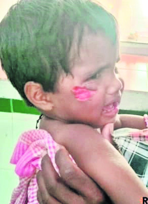 రెండేళ్ల చిన్నారిపై పిచ్చికుక్క దాడి 1