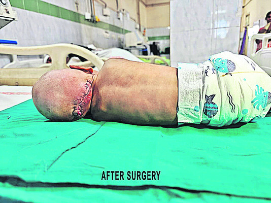 కేజీహెచ్‌లో అరుదైన శస్త్రచికిత్స1
