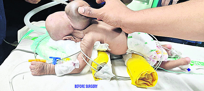 కేజీహెచ్‌లో అరుదైన శస్త్రచికిత్స2