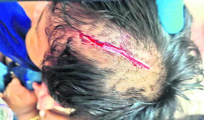 రెండేళ్ల పాపపై కుక్క దాడి1