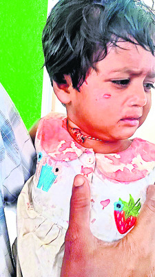 రెండేళ్ల పాపపై కుక్క దాడి2