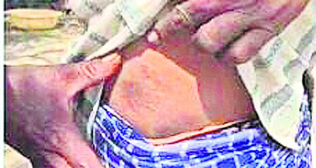 కలుషిత నీటితో గ్రామస్తులకు చర్మవ్యాధులు1