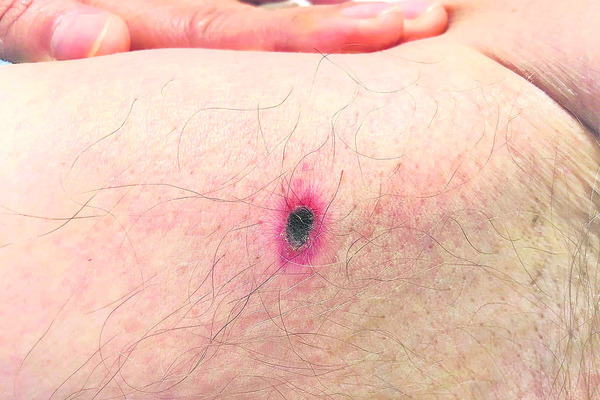 వామ్మో.. స్క్రబ్‌ టైఫస్‌! 2