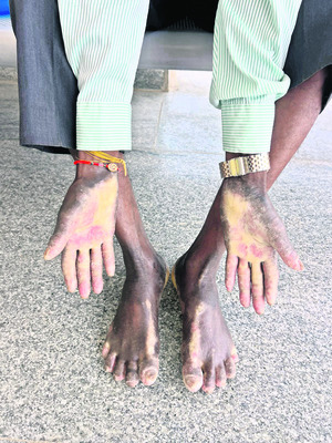 రేర్‌ డిసీజెస్‌.. బీ అలర్ట్‌! 2