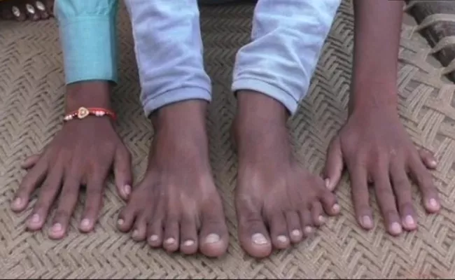 Relatives Want To Kill A Boy With 12 fingers And 12 toes In Barabanki - Sakshi