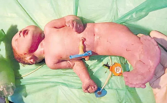 Baby Born As Fish Shape In Hyderabad - Sakshi