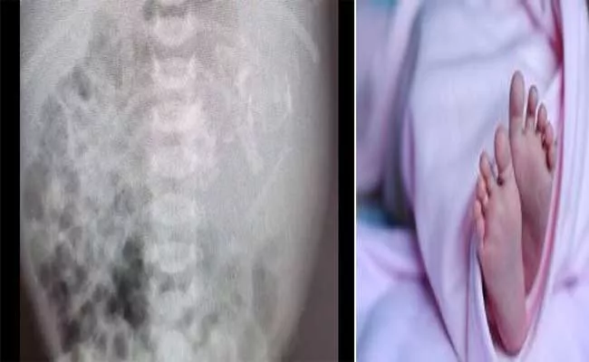 Newborn Baby Girl Had Twin Foetus Inside Her Stomach At Israel - Sakshi