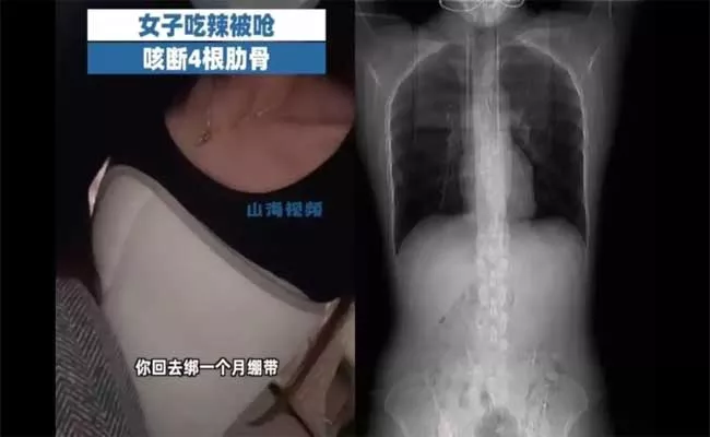 Chinese Woman Fractured Four Ribs Caughing After Eating Spicy Food - Sakshi