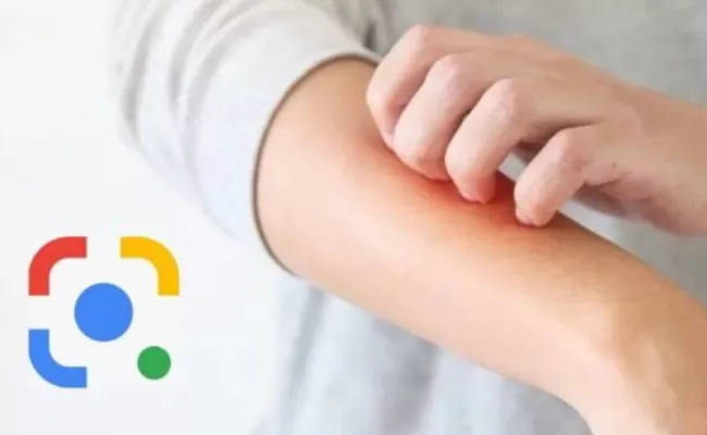 Google Lens can now detect skin conditions - Sakshi