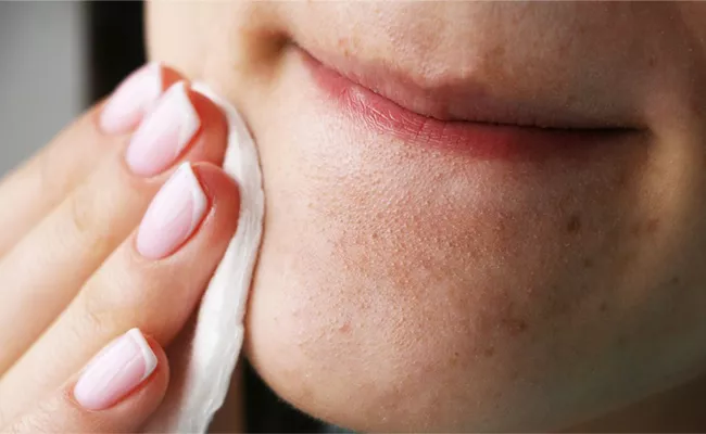 Are You Suffering From Blackheads Her Is The Solution For Blackheads - Sakshi