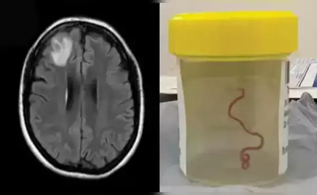 Doctors Detected An 8cm Long Living Worm In The Brain Of A Woman - Sakshi