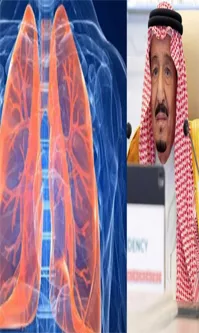 Saudi Arabias King Salmans Lung Infection: What Causes And Treatment