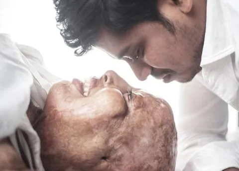 Acid Attack Survivor Finds Love During Treatment - Sakshi