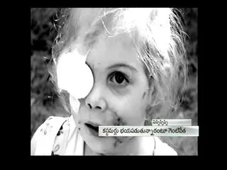KFC to pay medical bills for scarred girl - Sakshi