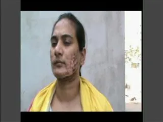 laser treatment Distorted in hyderabad - Sakshi