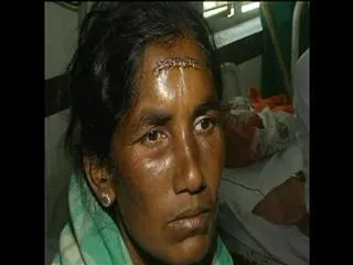rmp doctor makes stiches with staple pins to patient - Sakshi
