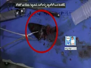 Fish stuck in the throat of young man in Khammam - Sakshi