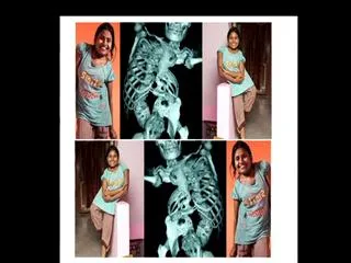 Indian girl whose spine is so twisted she's prepared to risk - Sakshi