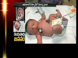 Baby girl born twice in Texas - Sakshi