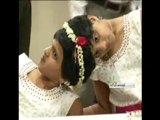 Australian Doctors Willing to Operate on Conjoined Twins Veena-Vani - Sakshi
