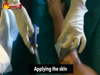 fish skin therapy for burn injuries - Sakshi