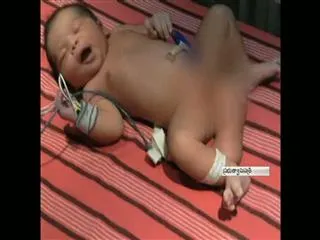 Indian girl born with THREE legs - Sakshi