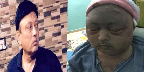Hyderabad Man Tariq loses eye after hair transplant - Sakshi