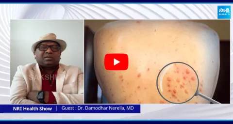 Dr Damodhar Nerella about Monkey Pox