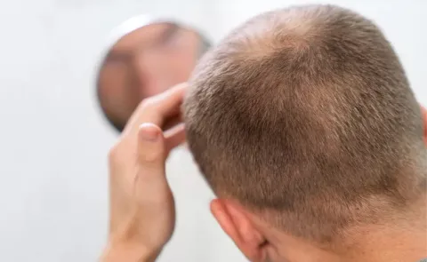 Doctor dies Bald Head in hyderabad