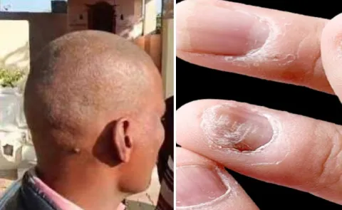 Buldhana: Initially Hair Now Nails Are Shedding