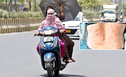 Skin Care in Hot Summer; Check full details inside
