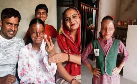 Dreaming of IAS 17 Year Old kafi Acid Attack Survivor Tops 12