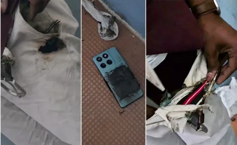 Annamayya District: Mobile Phone Explodes In Student Pants Pocket