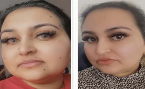 Beauty Tips: Non-Cancerous Mole Removal Beaumont Minor Surgeries
